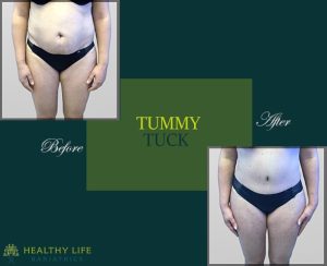 Tummy Tuck Surgery in Los Angeles CA