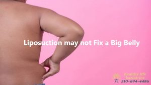 Liposuction may not always be effective in reducing a big belly.