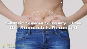 Gastric sleeve: Stomach Is Removed Los Angeles, CA