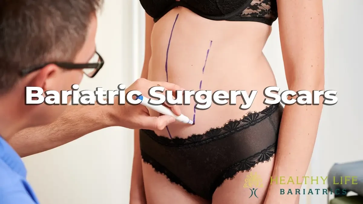 Bariatric Surgery Scars: What to Expect & How to Minimize Them