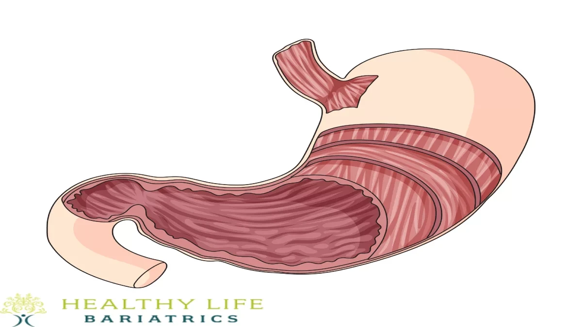 Endoscopic Revision of Gastric Sleeve 