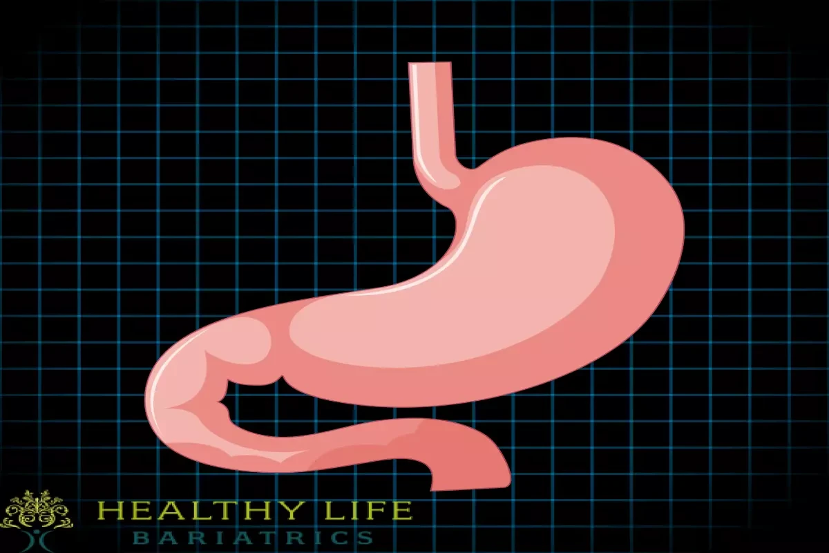 Endoscopic Sleeve Gastroplasty vs Sleeve Gastrectomy LA-CA