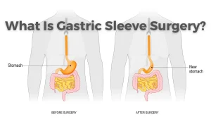 What is gastric sleeve surgery and how can it help with weight loss?