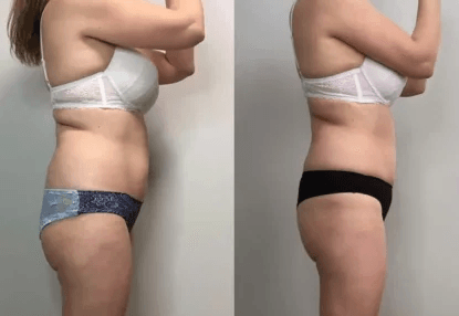 Two side-by-side images of a woman seen from the back, wearing a white bra and different color underwear, showing her torso and upper legs post-weight loss surgery in Los Angeles.