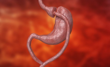 3d illustration of a human stomach against a red background, highlighting its structure and potential inflammation related to weight loss surgery.