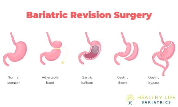 Bariatric Revision Surgery in Los Angeles, CA