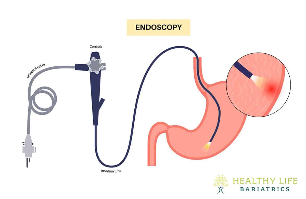 Endoscopic Sleeve Gastroplasty in LA, CA