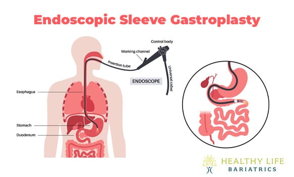 Endoscopic Sleeve Gastroplasty in Los Angeles CA