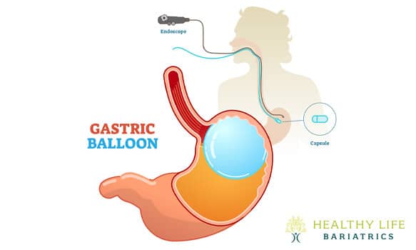 Gastric Balloon Surgery in Los Angeles, CA