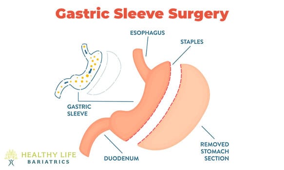 Gastric Sleeve Surgery in Los Angeles, CA