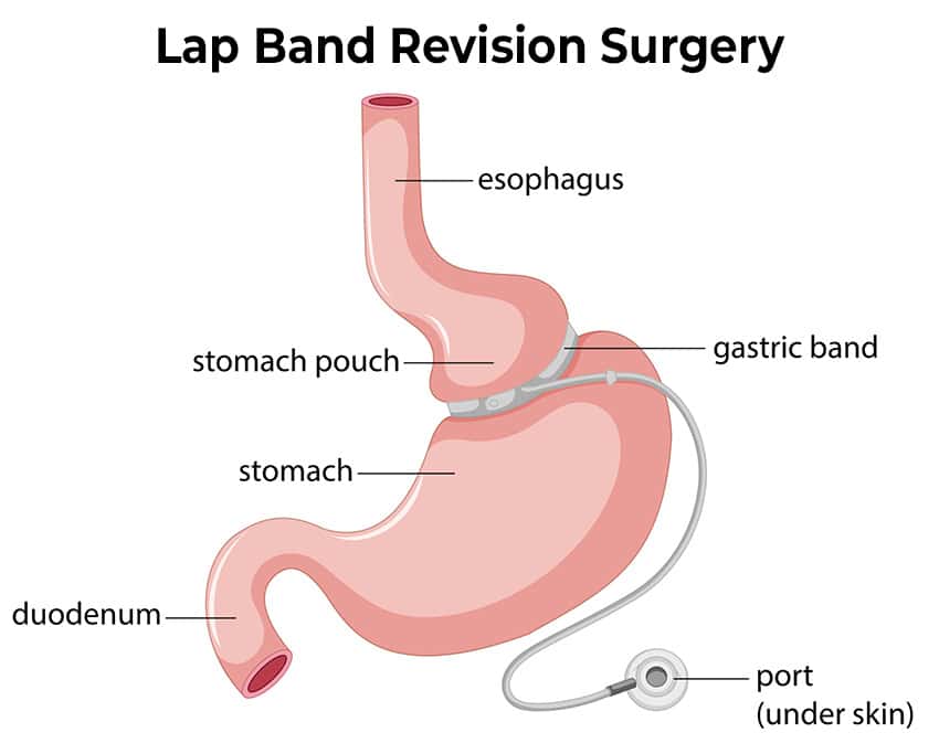 Lap Band Revision Surgery Los Angeles