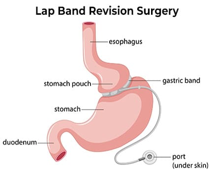 Lap Band Revision Surgery Los Angeles