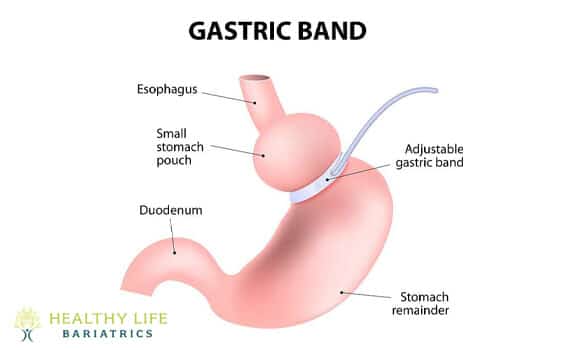 Lap Band Surgery in Los Angeles, CA