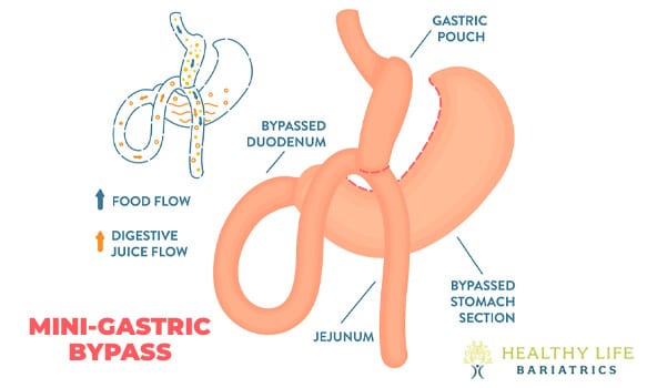 Mini Gastric Bypass in Los Angeles, CA