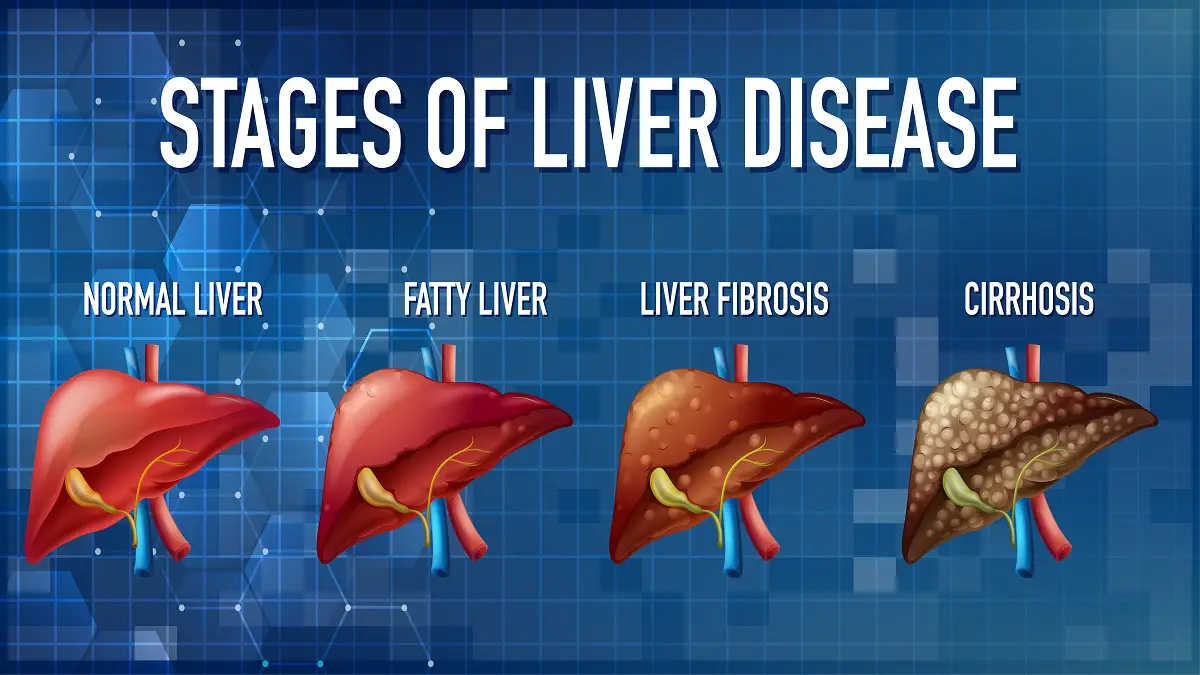 Gastric Sleeve Help Fatty Liver LA, CA