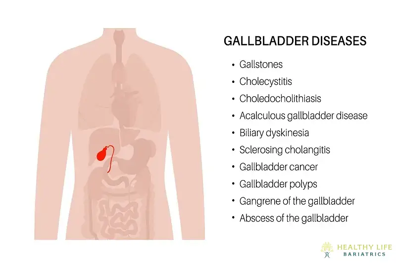 Acute Cholecystitis Diagnosis Testing in Los Angeles, CA