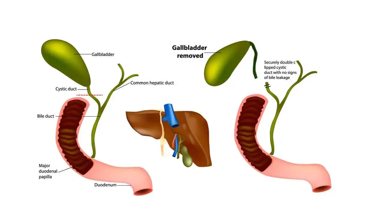 Acute Cholecystitis Treatment Los Angeles, CA