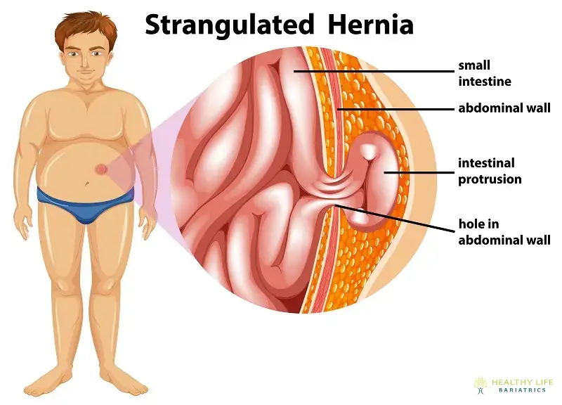 Advancements in Hernia Surgery in LA, CA