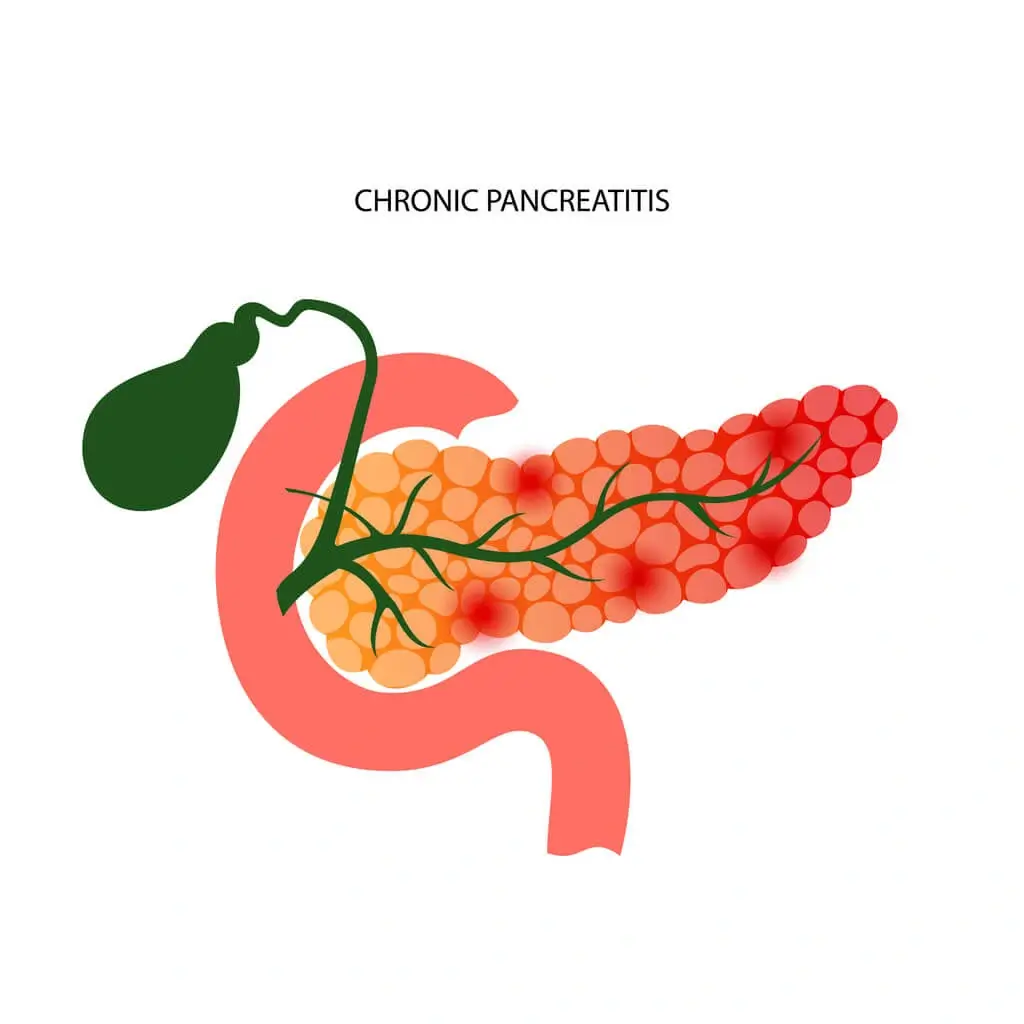 Chronic Cholecystitis or Acalculous Cholecystitis Surgery Los Angeles, CA