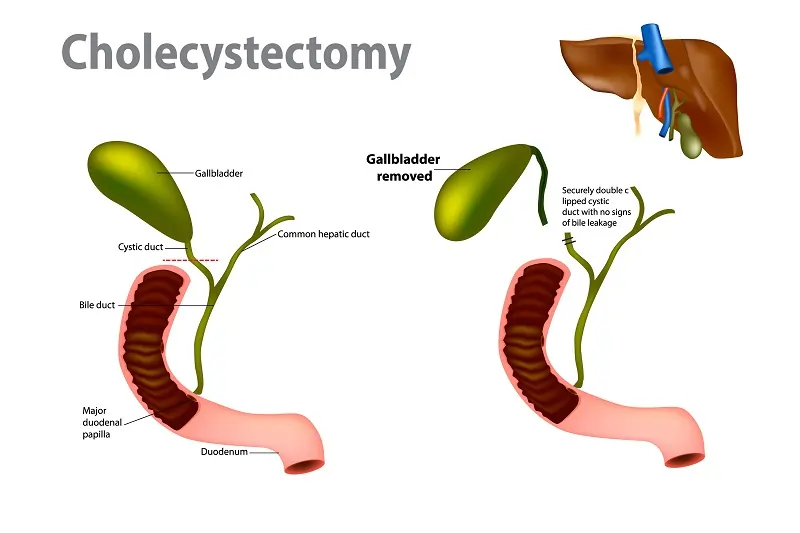 Costs of Gallbladder Surgery in Los Angeles