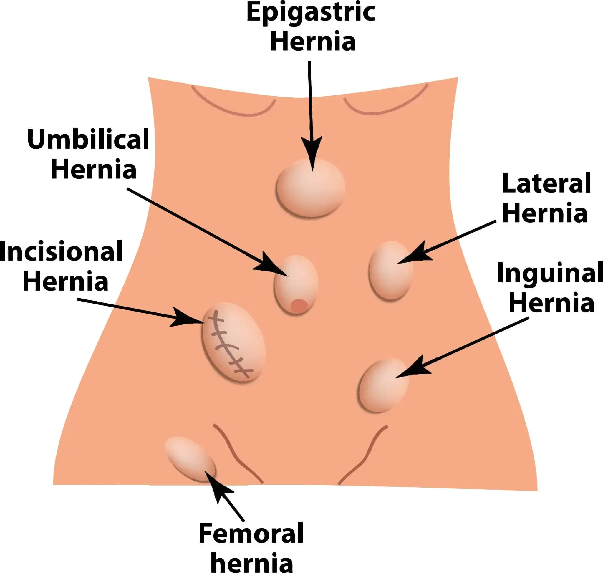 Epigastric Hernia Surgery Los Angeles, CA