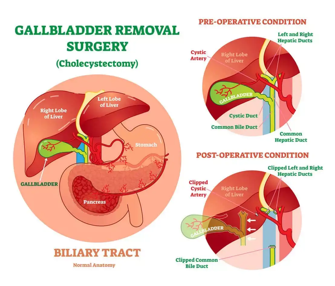 Gallbladder Surgery (Cholecystectomy) Gallstones in Los Angeles CA
