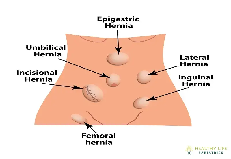 Types of Hernia Surgery Los Angeles, CA