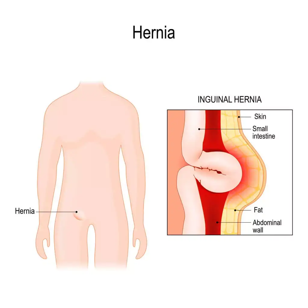 Hernia Surgery Los Angeles, CA