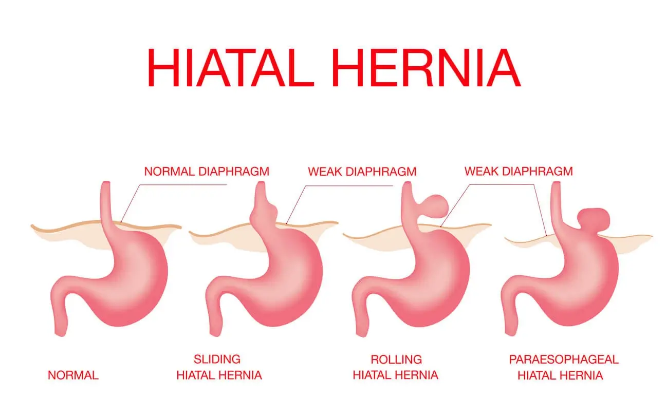 Hiatal Hernia Surgery in Los Angeles, CA