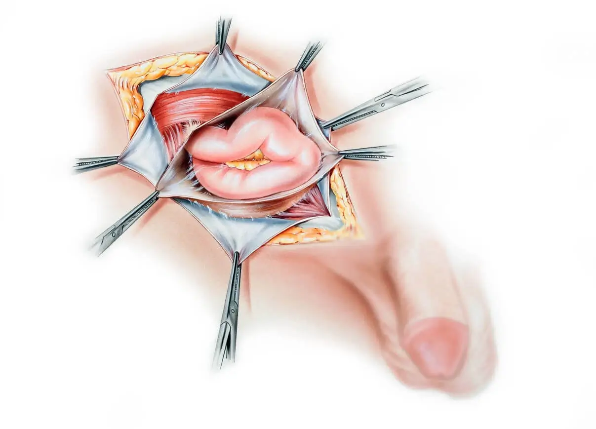 Inguinal Hernia Surgery in Los Angeles, CA