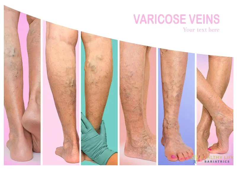 Laser Treatments for Varicose Vein Treatment LA, CA