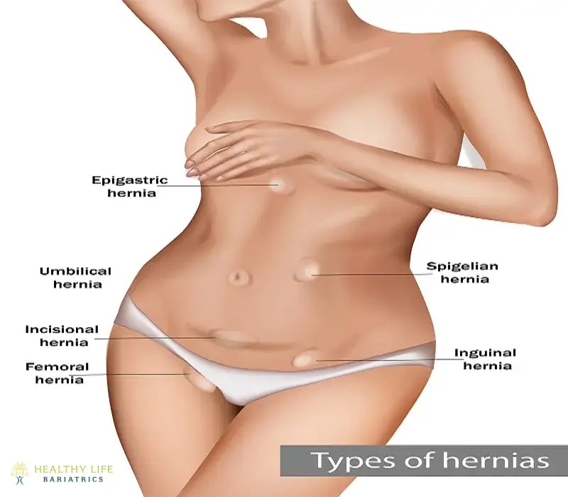 Hernia Surgery Los Angeles, CA