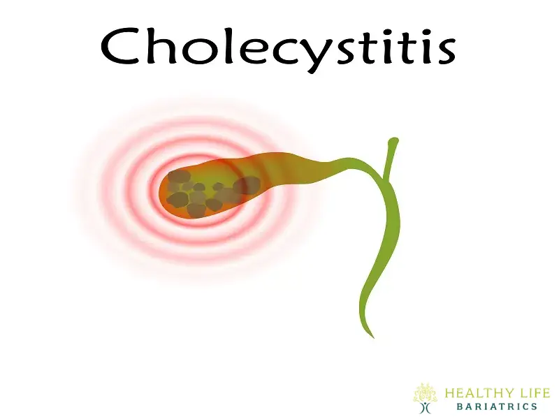 Recovery After Acute Cholecystitis Surgery