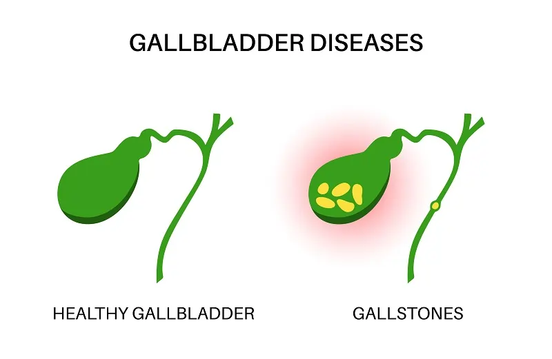 Recovery Expectations After Gallbladder Surgery in LA, CA