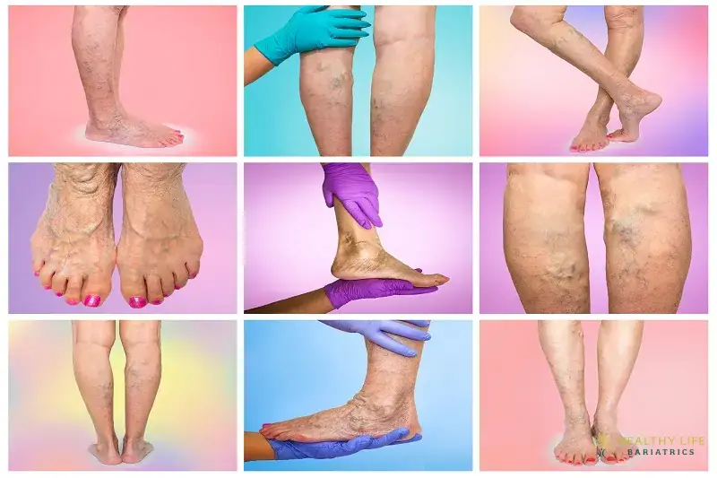 Risks and Complications Of Varicose Veins- LA, CA