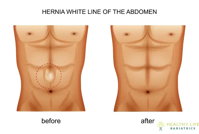 Recognizing the Signs of an Inguinal Hernia in Los Angeles, CA Physical examination alone suffices for most straightforward inguinal hernia diagnoses. Inspection and palpation while patients stand and cough elicit characteristic findings: Groin Bulge – The hernia sac protrusion becomes evident. Impulse on Coughing – Light finger pressure internalizes bulging tissue. Smooth Reducibility – Gently pushed tissues to slip back into normal abdomen anatomy readily. No Other Masses – Checking for enlarged lymph nodes or lipomas elsewhere proves essential. With obese body habitus obscuring exams or equivocal presentations, various imaging tests help confirm pathology: Herniogram – Dye injected at the groin enables mapping hernia sack communications. CT Scan – Thin sliced axial groin imaging reveals muscular defects that are not apparent externally. MRI – Assesses soft tissues without radiation but rarely necessitates. If you are in Los Angeles, CA, and suspect you have an inguinal hernia, trust surgeon Dr. Moein at Healthy Life Bariatrics for expert care. An official diagnosis is required before hernia correction surgery can be performed. Delaying treatment may lead to serious complications, so don’t wait to address your symptoms. You can call (310)861-4093 today to schedule a consultation with Dr. Moein, a leading expert in inguinal hernia treatment in Los Angeles. What Causes an Inguinal Hernia? An inguinal hernia could occur because of increased pressure inside the abdomen. You might have a preexisting weak spot in your abdominal muscles. Other causes include straining during bowel movements, strenuous exercise, pregnancy, and chronic sneezing or coughing. Many people with inguinal hernias have weakened abdominal walls. The muscles may not have adequately formed in the womb. The muscles also become weaker with age. The older you get, the more at risk you are for experiencing one of these hernias. In men, the weakened spot usually occurs in the inguinal canal, where the spermatic cord enters the scrotum. The inguinal canal houses a ligament that stabilizes the uterus in women. Hernias sometimes occur in women when connective tissue from the uterus attaches to pubic bone tissue. Congenital Anatomic Defect – Existing since birth when abdominal wall fusion through the inguinal canal fails. Heavy Lifting/Strain – Chronic coughing fits, constipation from straining to defecate, obesity weight or intense vomiting episodically increase abdominal pressures. Prior Surgery – Any prior abdominal operations resulting in weakened scar tissue could contribute. Family Tendency – Inheritable connective tissue disorders like Ehlers-Danlos Syndrome predispose some patients. Smoking – Chemical carcinogens and chronic obstructive lung disease exacerbating coughs impair tissue integrity over decades. Aging – All muscles and fascial connective tissues naturally weaken over time. Men over 45 years and women over 60 years old have substantially higher hernia risks, even without clear inciting events. Signs of an Inguinal Hernia in Los Angeles, CA