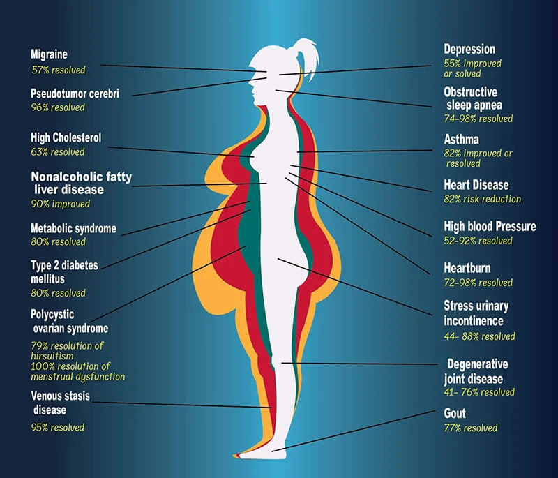  The benefit of Bariatric Surgery in Los Angeles, CA