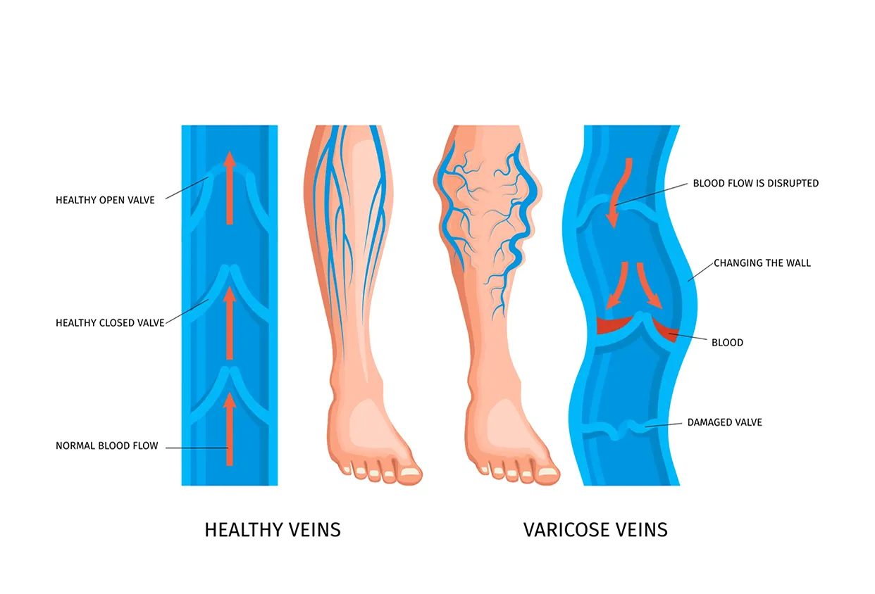 Varicose Vein Treatment by Top Vein Specialist Los Angeles, CA