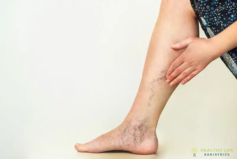 What Triggers Varicose Veins in Los Angeles, CA