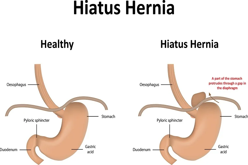 Factors influencing Hiatal Hernia Surgery decision