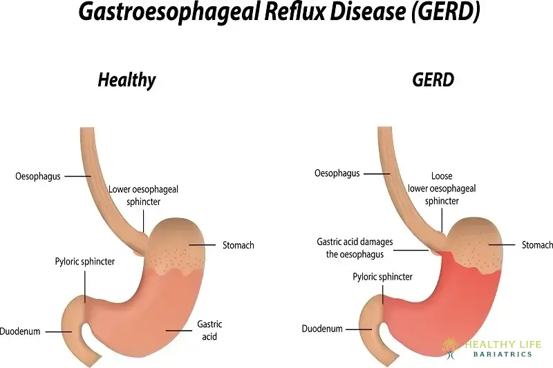 Impact of Gastroesophageal Reflux Disease (GERD)