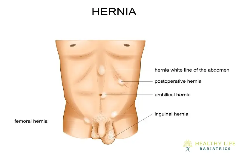 Suggested Materials For Post Hernia Surgery LA, CA