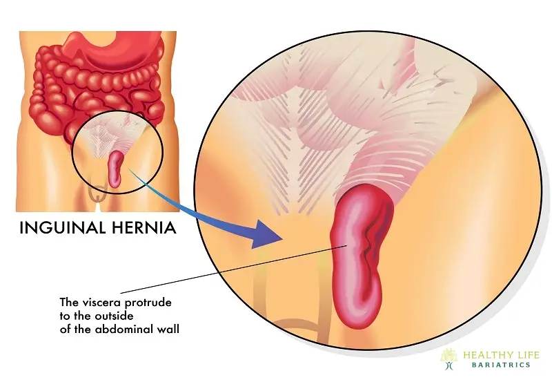 What to wear after inguinal hernia surgery: Layering Techniques