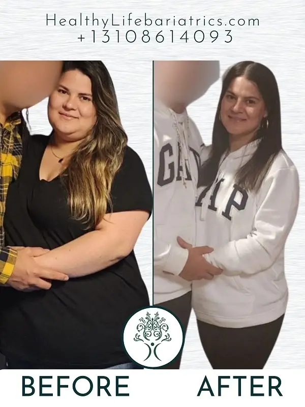 Bariatric Surgery- Gastric Bypass Before and After LA Bariatric Surgery- Gastric Bypass Before and After LA