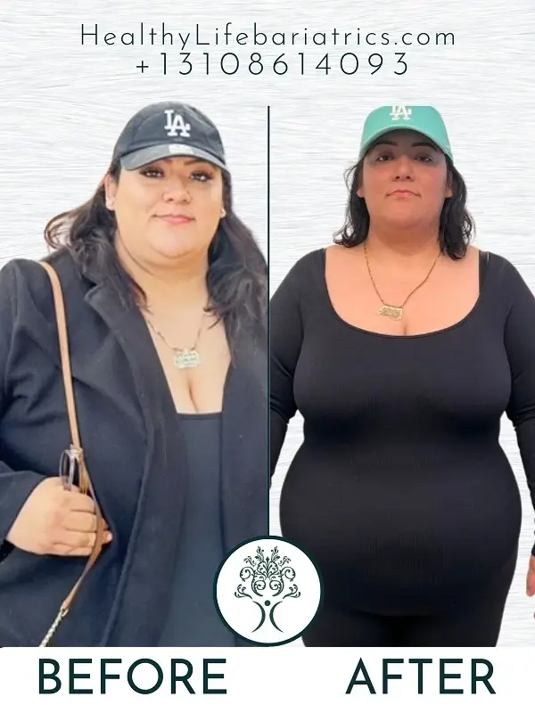 Bariatric Surgery- Gastric Sleeve Before and After Bariatric Surgery- Gastric Sleeve Before and After