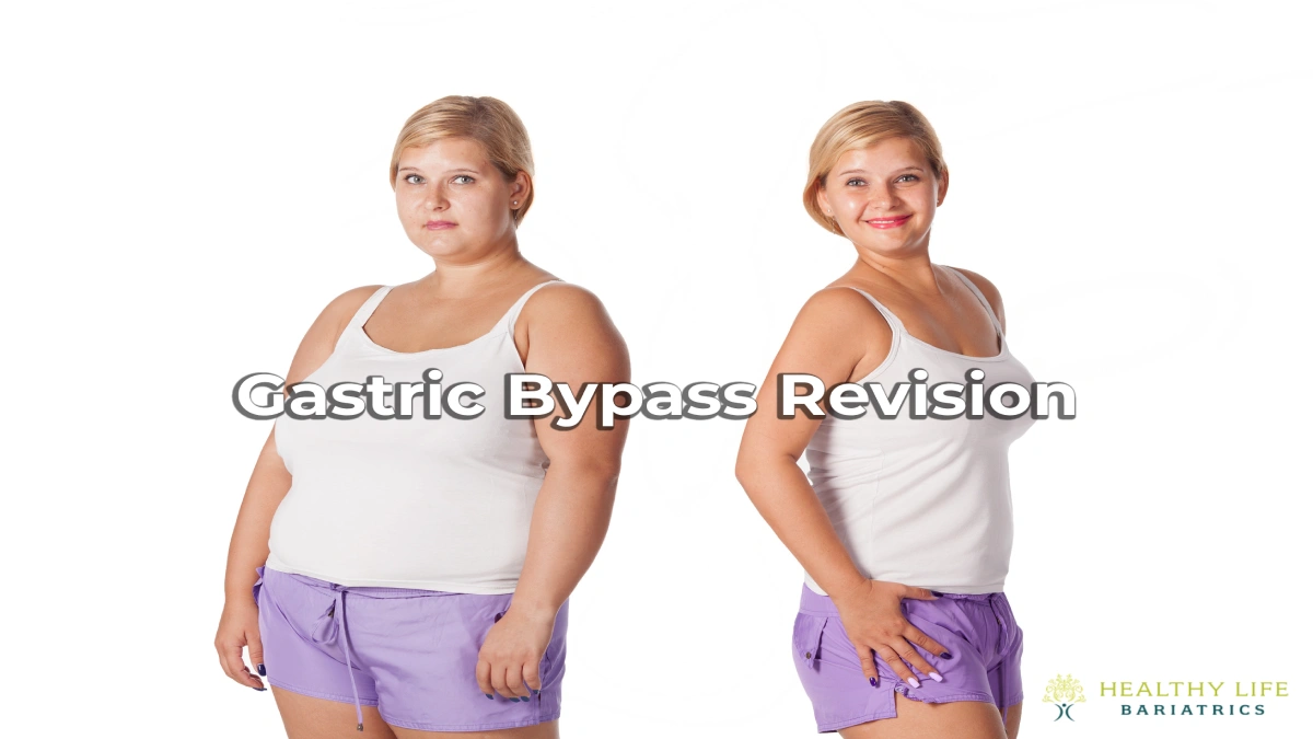 Gastric Bypass Revision