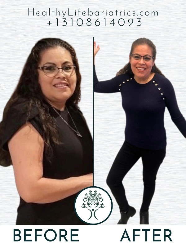 Gastric Sleeve Before and After LA, CA Gastric Sleeve Before and After LA, CA