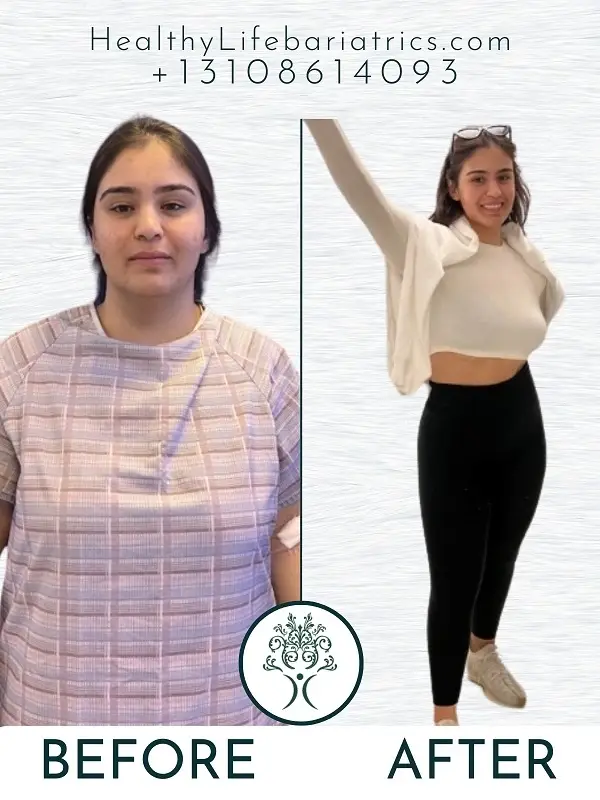 Gastric Sleeve Before and After in LA, CA Gastric Sleeve Before and After in LA, CA