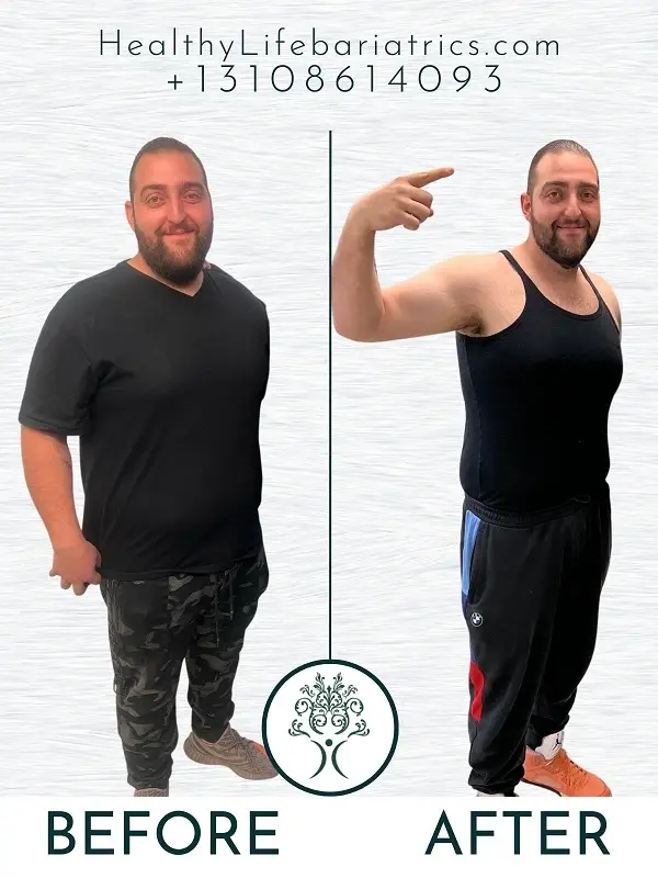 Gastric Sleeve Before and After in Los Angeles, CA Gastric Sleeve Before and After in Los Angeles, CA