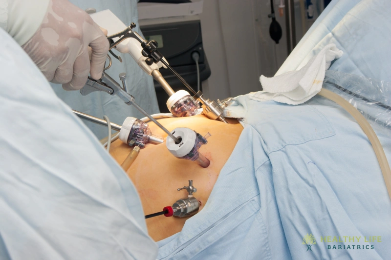 Long-term Outcomes Gastric Bypass Revision